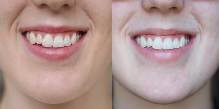 transformation-at-home-teeth-whitening-smile-brilliant